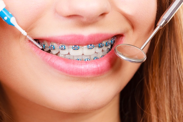 Braces Near Me: Tips To Help Prepare For Treatment