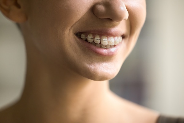 What To Know Before Getting Ceramic Braces