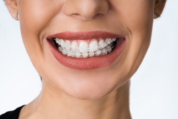 Clear Braces: What Makes A Good Candidate?