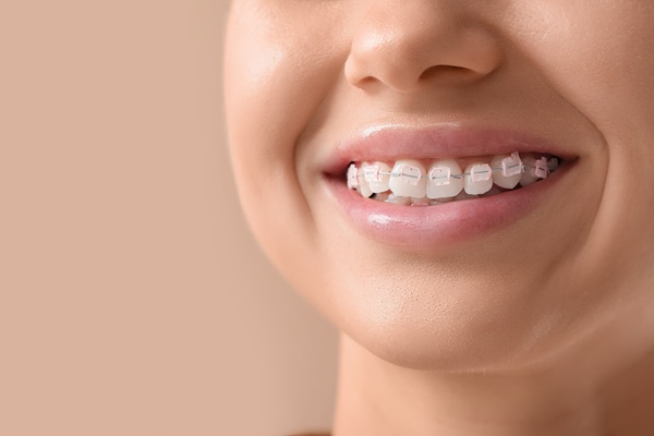 What Are Corrective Braces?