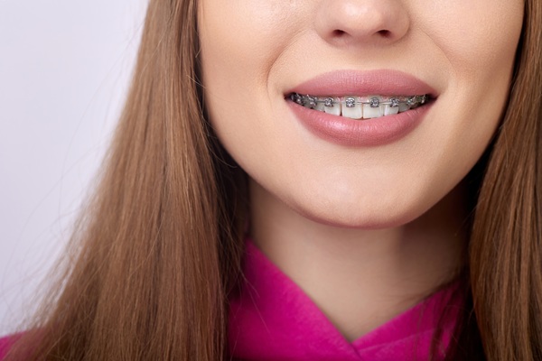 What Are Damon Braces?