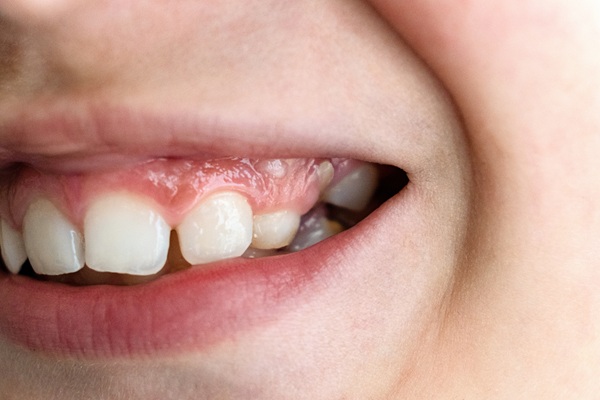 Signs Your Child May Need Early Orthodontic Treatment