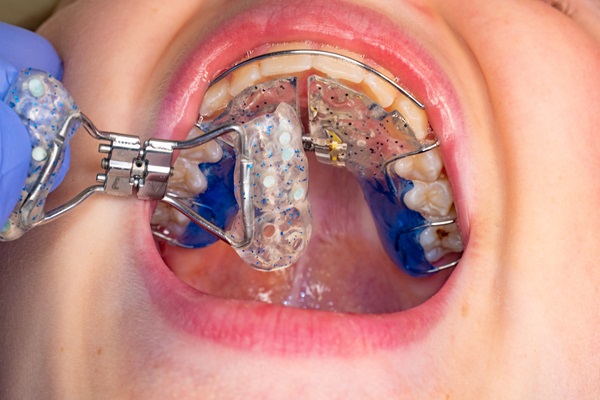 When And Why Expanders Are Recommended By Orthodontists