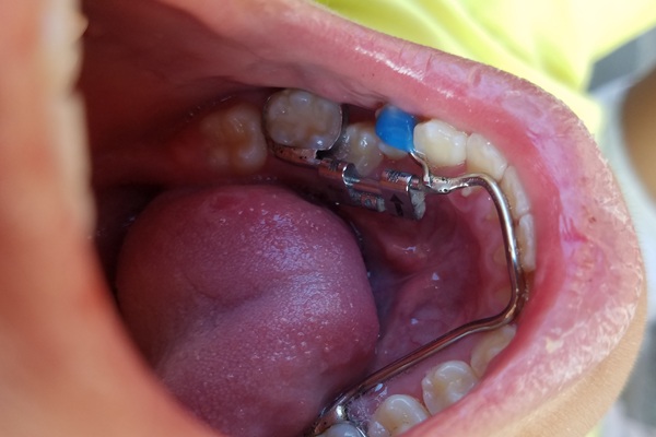 Understanding Space Maintainers: Benefits For Growing Smiles